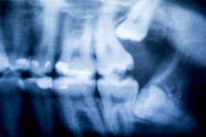 5 Facts About Wisdom Teeth