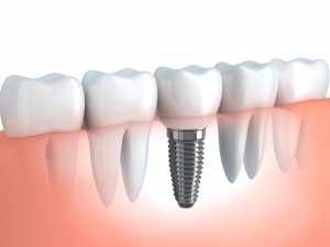 The Rookie Guide to Dental Implants